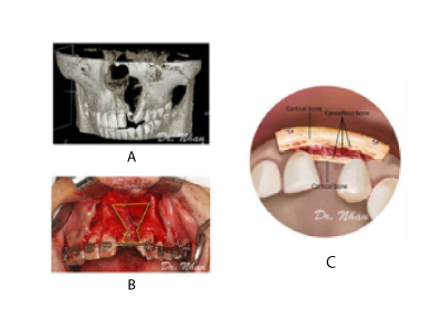 Công trình đã được đăng trên tạp chí The Cleft Palate Craniofacial Journal 2018 Công trình đã được đăng trên tạp chí The Cleft Palate Craniofacial Journal 2018