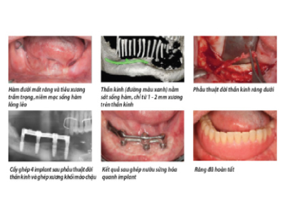 Công trình được công bố trên tạp chí Journal of Oral and Maxillofacial Surgery năm 2020 Công trình được công bố trên tạp chí Journal of Oral and Maxillofacial Surgery năm 2020