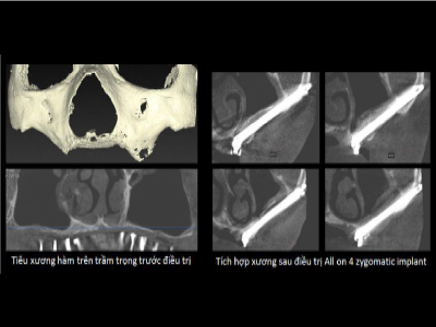 Công trình đã được báo cáo tại hội nghị quốc tế về Phẫu thuật Miệng và Hàm Mặt (ICOMS) Công trình đã được báo cáo tại hội nghị quốc tế về Phẫu thuật Miệng và Hàm Mặt (ICOMS)