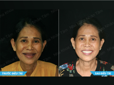 công bố tóm tắt trên tạp chí International Journal of Oral and Maxillofacial Surgery công bố tóm tắt trên tạp chí International Journal of Oral and Maxillofacial Surgery
