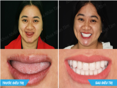 Công trình công bố trên tạp chí International of Oral and Maxillofacial Surgery2017 Công trình công bố trên tạp chí International of Oral and Maxillofacial Surgery2017