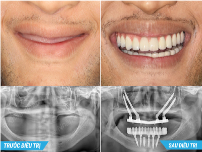 kết hợp 2 kỹ thuật dời thần kinh và Implant xương gò má cải tiến (2016) kết hợp 2 kỹ thuật dời thần kinh và Implant xương gò má cải tiến (2016)
