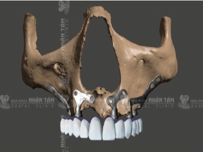 kỹ thuật implant cá nhân hóa kỹ thuật implant cá nhân hóa