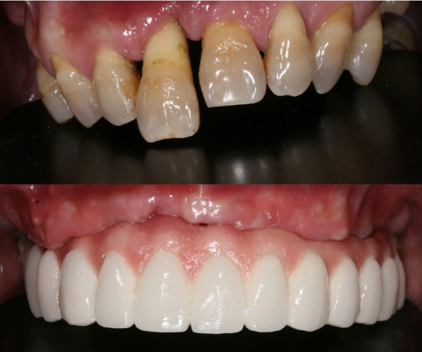 Cấy ghép implant phục hồi toàn diện chức năng nhai Cấy ghép implant phục hồi toàn diện chức năng nhai