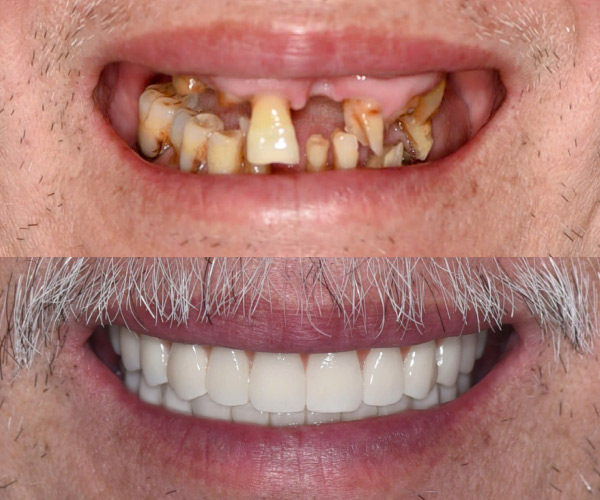 người mất răng mất răng toàn bộ người mất răng mất răng toàn bộ