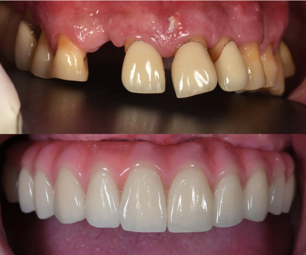 Cấy ghép implant vùng thẩm mỹ Cấy ghép implant vùng thẩm mỹ