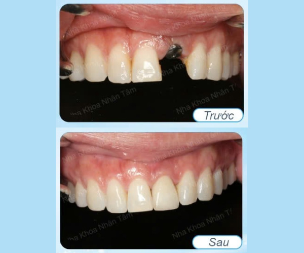 Cấy ghép implant vùng thẩm mỹ 2 Cấy ghép implant vùng thẩm mỹ 2