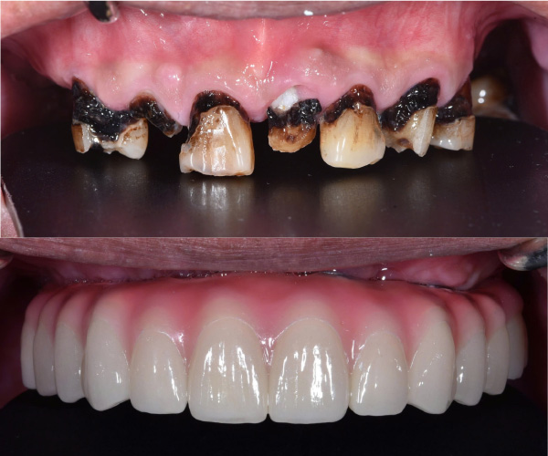 Nghiên cứu cấy ghép răng cho bệnh nhân đặc biệt Nghiên cứu cấy ghép răng cho bệnh nhân đặc biệt