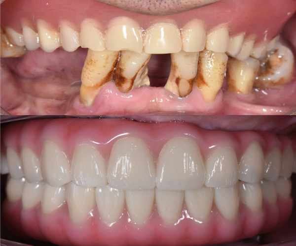 bệnh nhân sau điều trị ung thư bệnh nhân sau điều trị ung thư