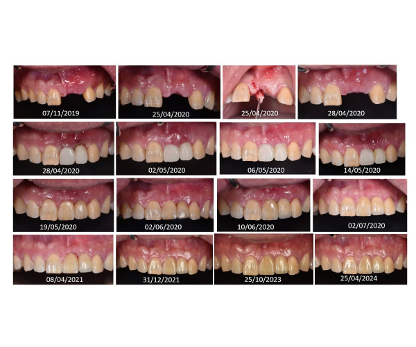 Nghiên cứu tái sinh xương Nghiên cứu tái sinh xương