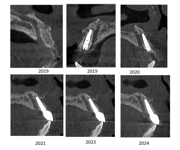 tái sinh mô nướu trong phẫu implant tái sinh mô nướu trong phẫu implant