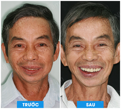 Dời thần kinh hàm dưới để cấy ghép răng Implant Dời thần kinh hàm dưới để cấy ghép răng Implant