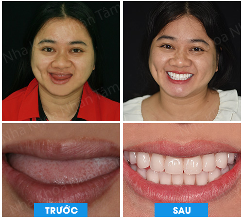 Dời dây thần kinh hàm dưới và cấy ghép Implant xương gò má hàm trên cho bệnh nhân thiếu răng bẩm sinh Dời dây thần kinh hàm dưới và cấy ghép Implant xương gò má hàm trên cho bệnh nhân thiếu răng bẩm sinh