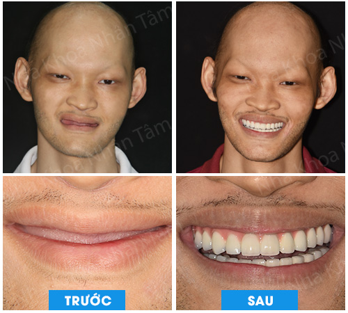 Dời dây thần kinh hàm dưới và cấy ghép Implant xương gò má hàm trên cho bệnh nhân không răng bẩm sinh Dời dây thần kinh hàm dưới và cấy ghép Implant xương gò má hàm trên cho bệnh nhân không răng bẩm sinh